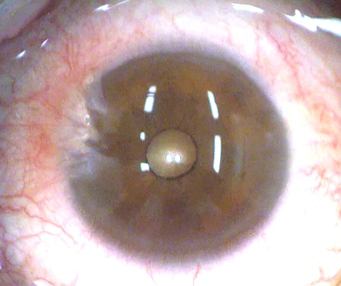 pterygium_1