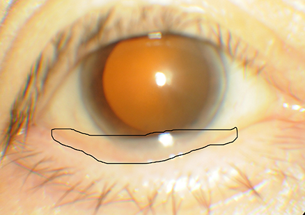 conjunctiva_laxity_1